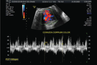 Ultrasonido Doppler a color