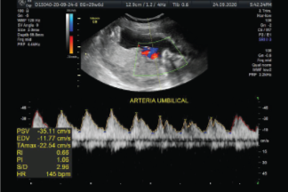 Ultrasonido Doppler a color
