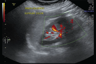 USG Doppler color