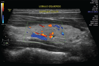 USG Doppler color